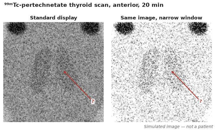 ⁹⁹ᵐTc-pertechnetate anterior neck image at 20 min, standard display and the same image with a narrow window. Measured thyroid uptake 0.2% (departmental reference range 0.4–3%). Arrows mark the thyroid bed.