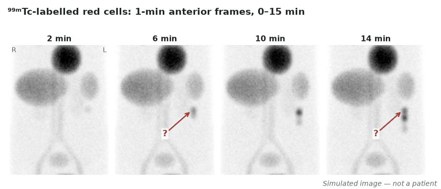 Simulated ⁹⁹ᵐTc-labelled red-cell study (in vitro labelling): 1-min anterior frames at 2, 6, 10 and 14 min.