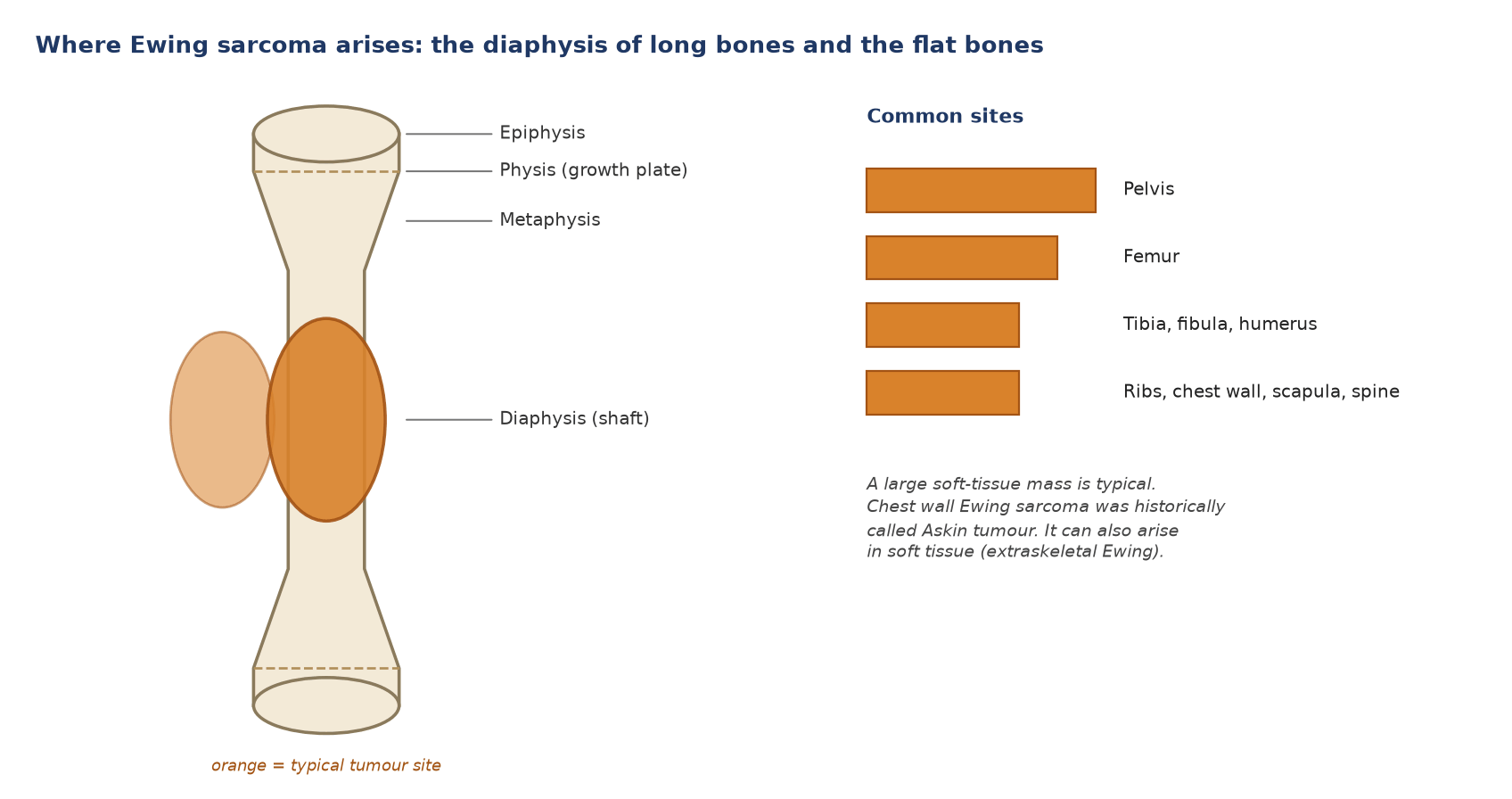 Ewing sarcoma arises in the diaphysis of long bones and in the flat bones, with a large soft-tissue mass.