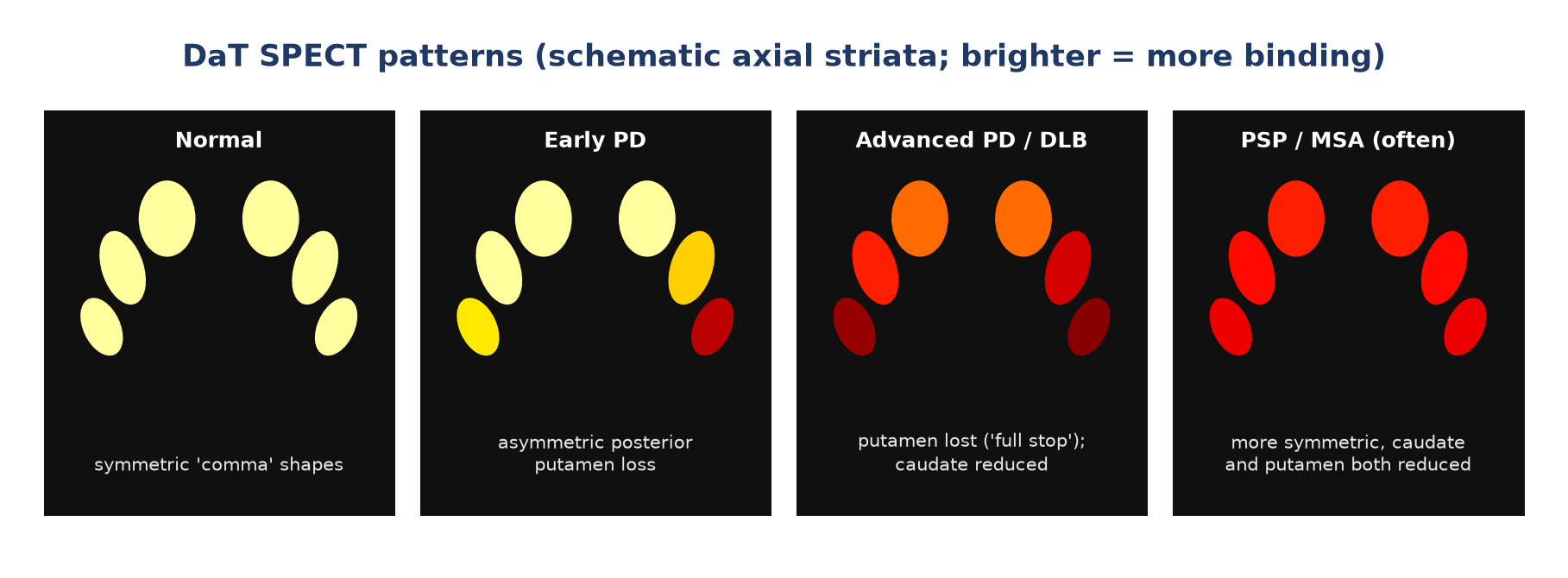 Typical DaT SPECT patterns (schematic).