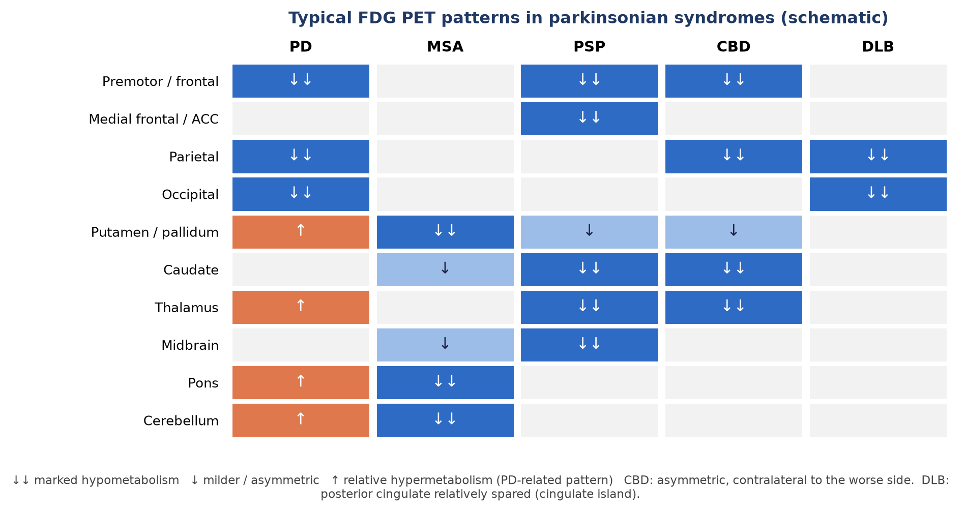 Typical regional FDG changes in parkinsonian syndromes (schematic).