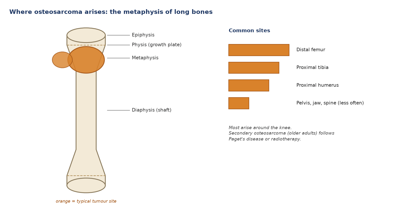 Osteosarcoma arises in the metaphysis of long bones, most often around the knee.