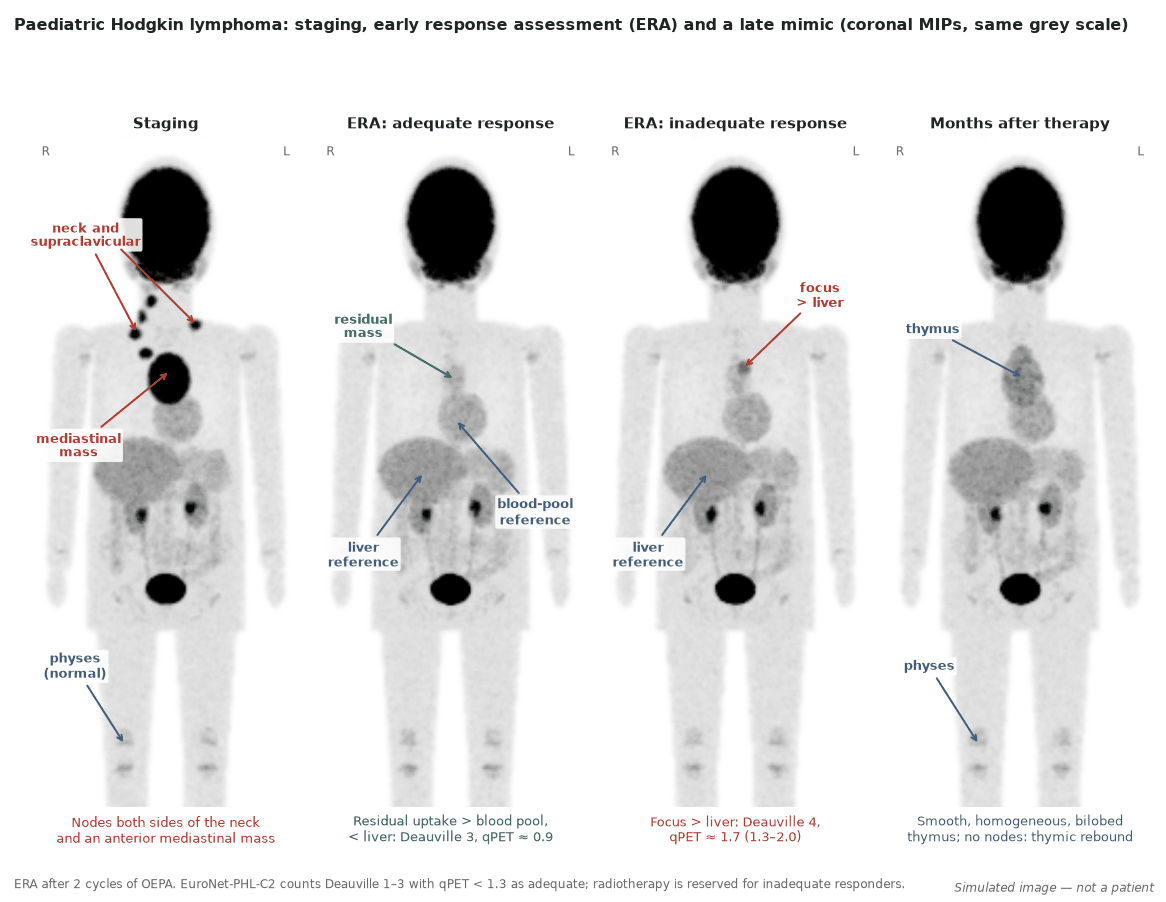 Simulated coronal MIPs in a child with Hodgkin lymphoma: staging; an adequate early response (residual uptake between blood pool and liver, Deauville 3, qPET about 0.9); an inadequate response (focus above liver, Deauville 4, qPET about 1.7); and, months after therapy, smooth bilobed thymic uptake with no nodal disease (thymic rebound). Open physes at the knees and ankles are normal.