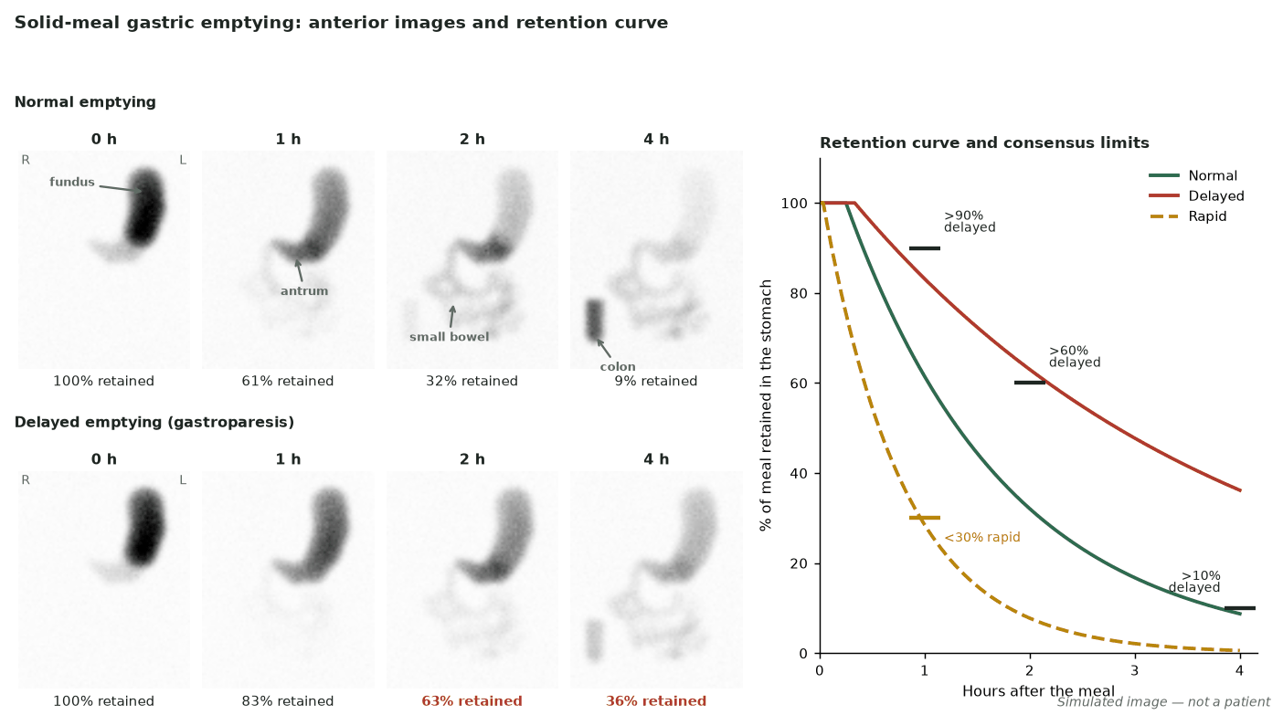 Simulated anterior gastric-emptying images at 0, 1, 2 and 4 hours for normal and delayed emptying, beside retention curves with the consensus limits of 90% at 1 hour, 60% at 2 hours and 10% at 4 hours, and 30% at 1 hour for rapid emptying.