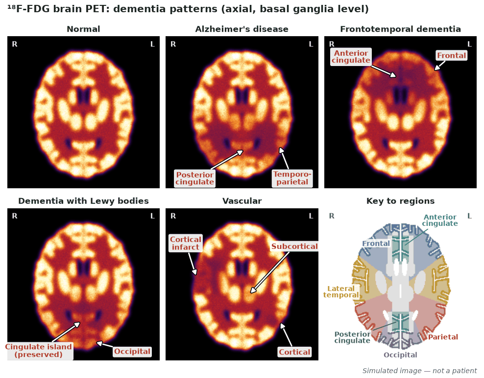 Five simulated axial FDG PET slices showing normal metabolism and the Alzheimer, frontotemporal, Lewy body and vascular hypometabolism patterns, with a colour key to the brain regions.