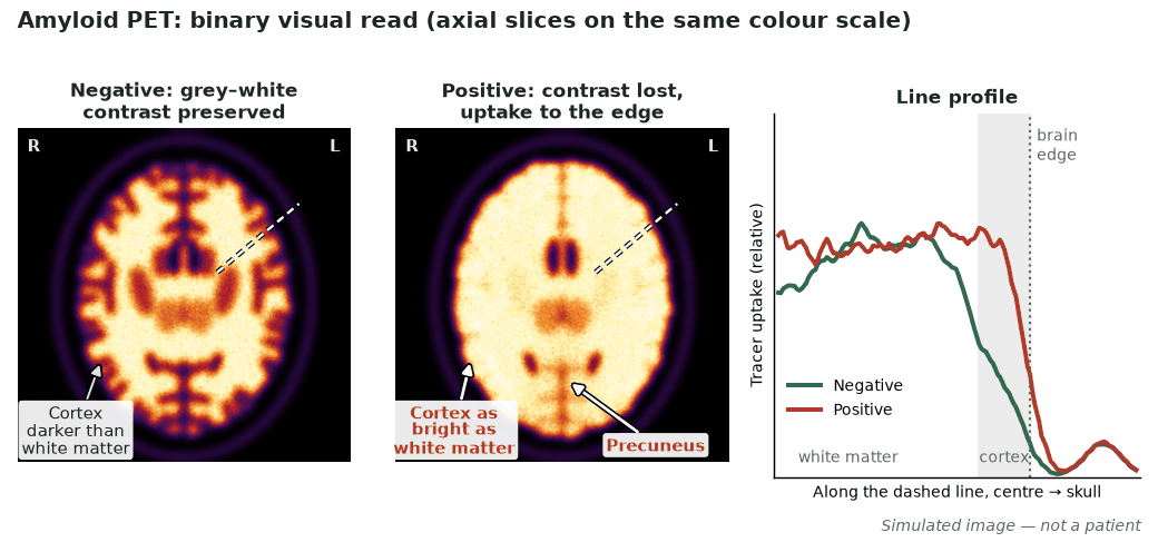 Two simulated axial amyloid PET slices on the same colour scale, a negative scan with darker cortex than white matter and a positive scan with bright cortex reaching the brain edge, and a line profile comparing them.