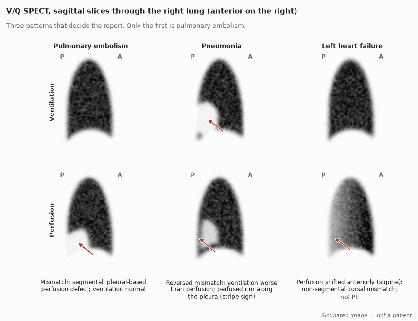 Simulated sagittal V/Q SPECT slices of the right lung in three conditions: PE with a wedge perfusion defect and normal ventilation; pneumonia with a ventilation defect larger than the perfusion defect and a perfused pleural rim; left heart failure with perfusion shifted anteriorly.