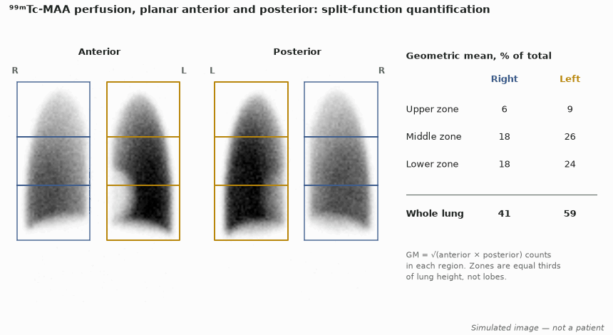 Simulated planar anterior and posterior ⁹⁹ᵐTc-MAA perfusion images with three rectangular zones over each lung and a table of geometric-mean percentages: right lung 41%, left 59%, right upper zone lowest at 6%.