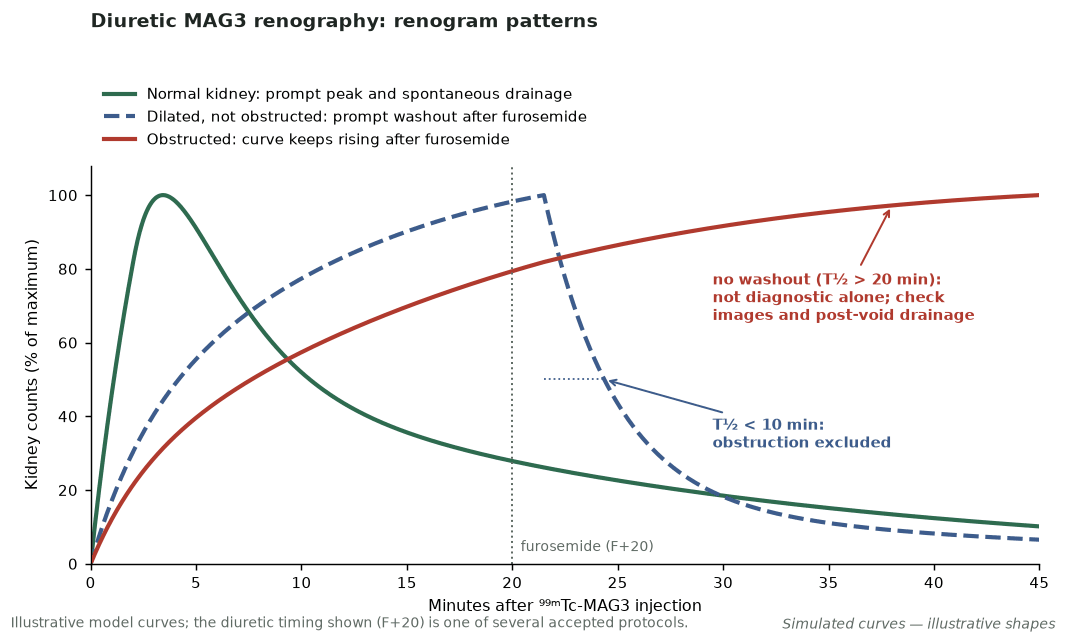 Simulated MAG3 renogram curves for a normal kidney, a dilated but unobstructed kidney that washes out promptly after furosemide at 20 minutes, and an obstructed kidney whose curve keeps rising.